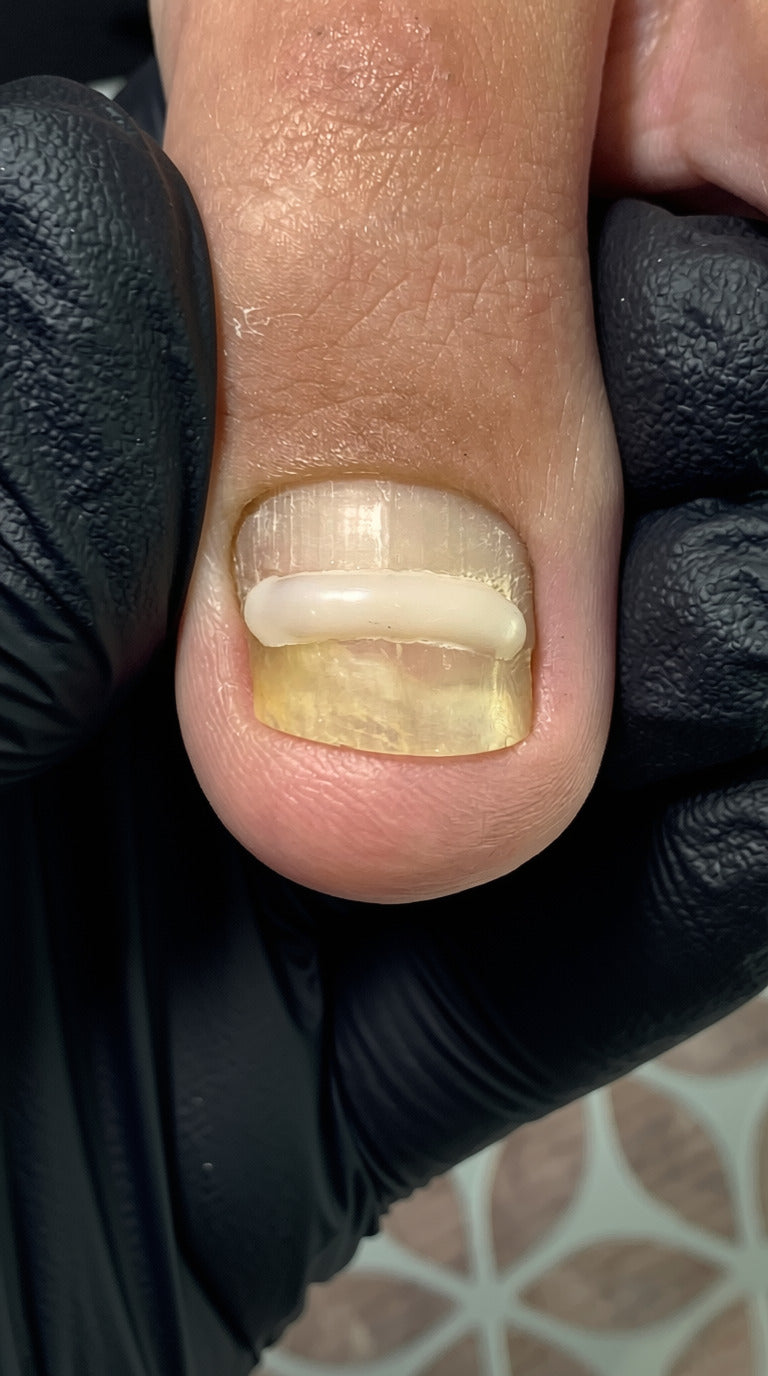 A close-up of a short damaged toenail showing yellowed lifting from moisture trap underneath, l with a black gloved hand holding it. The nail has an old onyfix band to help uncurve the nail. The nail is showing evidence of vertical keratin lines indicating it could be brittle