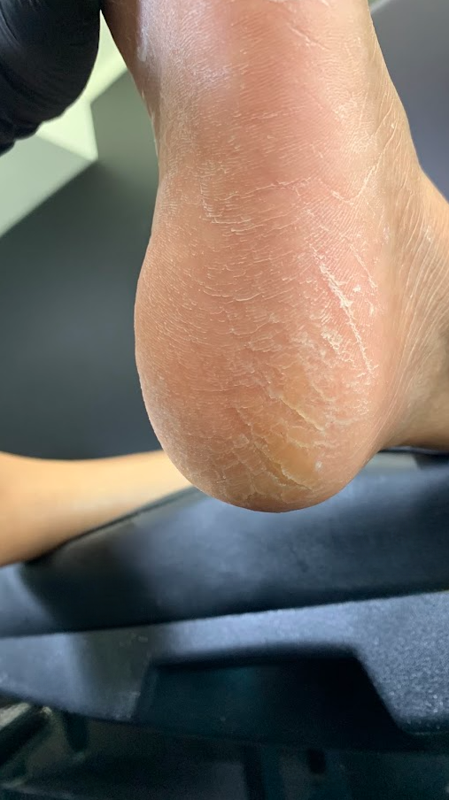 DRY* Cracked Heel Overhaul (Initial Service)