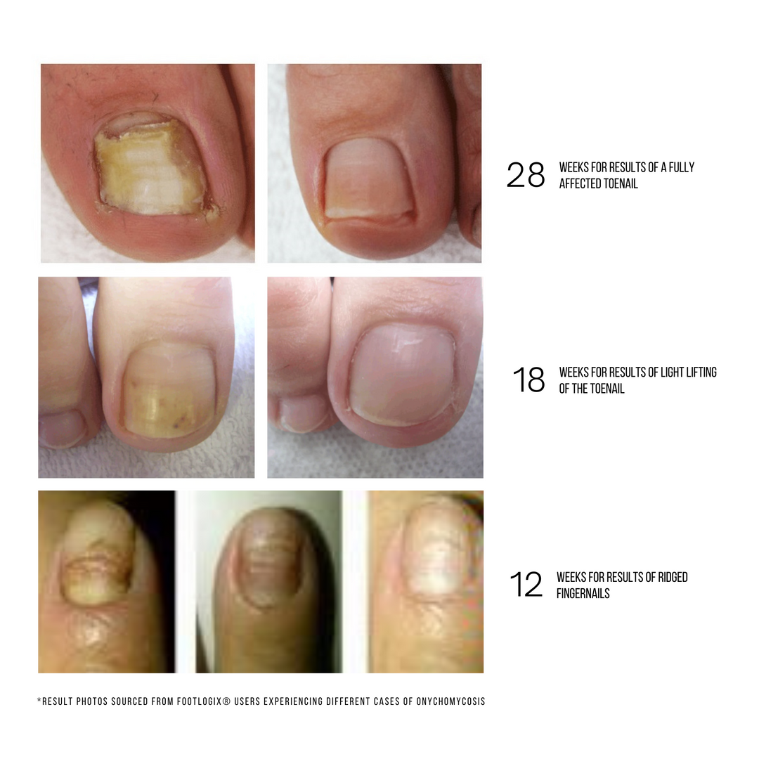 Footlogix® Nail Tincture Spray
